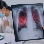 La tuberculosis es curable si se detecta y trata oportunamente.